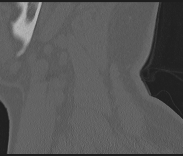 Cervical disc replacement (Radiopaedia 44025-47541 Sagittal bone window 11).png