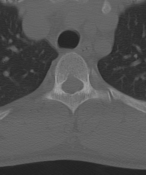 Cervical intercalary bone (Radiopaedia 35211-36748 Axial bone window 73).png