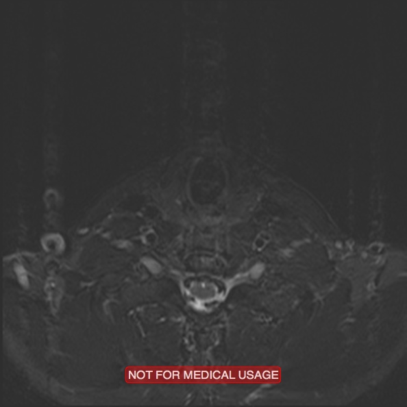 Cervical nerve schwannoma (Radiopaedia 27964-28221 C 42).jpg