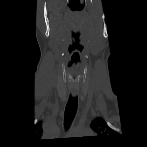 Cervical schwannoma (Radiopaedia 57979-64974 Coronal bone window 15).png