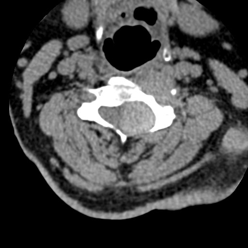 File:Cervical spinal neurofibroma in a patient with NF1 (Radiopaedia 58344-65464 Axial non-contrast 37).jpg