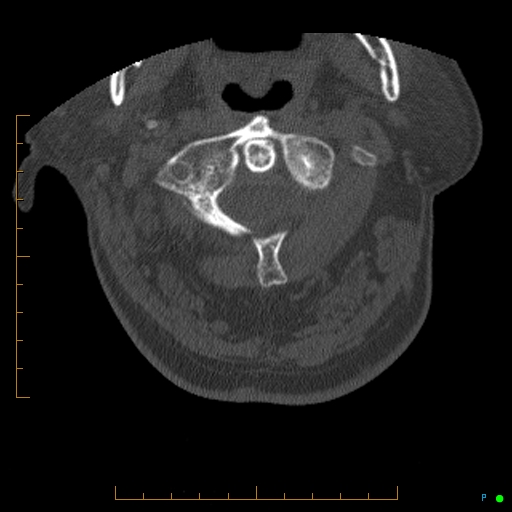 File:Cervical spine fracture - ankylosing spondylitis (Radiopaedia 76835-88706 Axial bone window 36).jpg