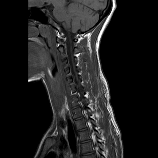 File:Cervical spine posterior ligamentous complex rupture (Radiopaedia 63486-72103 Sagittal T1 9).jpg