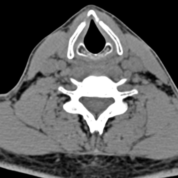 File:Cervical spondylodiscitis (Radiopaedia 28057-29489 Axial non-contrast 53).jpg