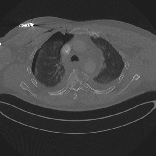 File:Chest multitrauma - aortic injury (Radiopaedia 34708-36147 Axial bone window 102).png