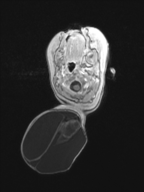 Chiari III malformation with occipital encephalocele (Radiopaedia 79446-92559 Axial T1 C+ mpr 26).jpg