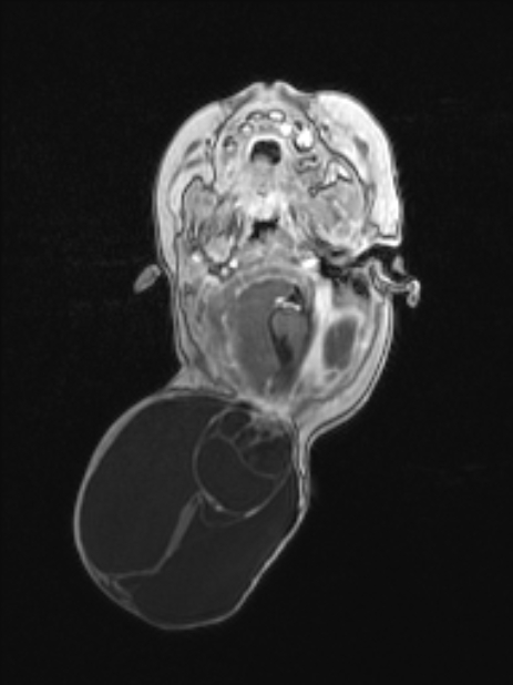 Chiari III malformation with occipital encephalocele (Radiopaedia 79446-92559 Axial T1 C+ mpr 32).jpg