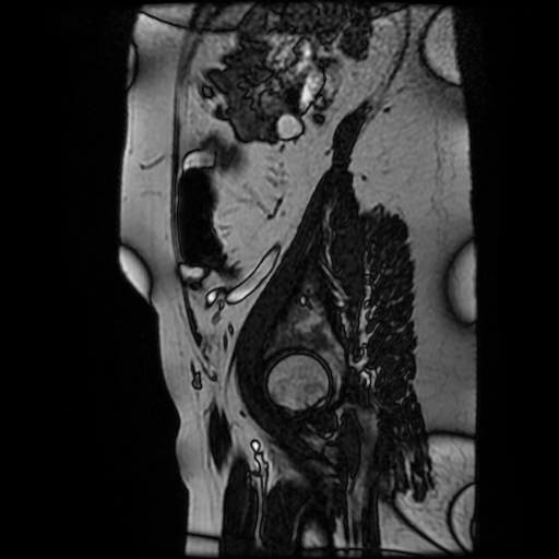 Chiari II malformation - fetal MRI (Radiopaedia 68099-77581 Sagittal Fiesta 50).jpg