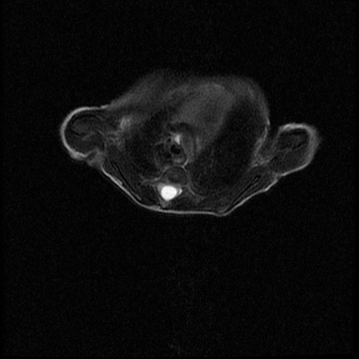File:Chiari II malformation with spinal meningomyelocele (Radiopaedia 23550-23652 Axial T2 3).jpg