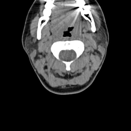 File:Chiari I malformation and obstructive hydrocephalus (Radiopaedia 41185-43981 D 39).png