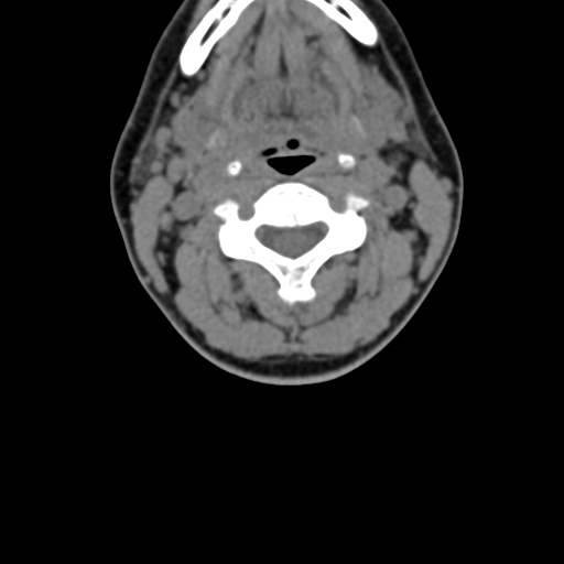 Chiari I malformation and obstructive hydrocephalus (Radiopaedia 41185-43981 D 47).png