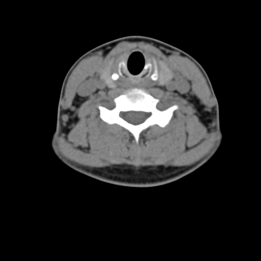 File:Chiari I malformation and obstructive hydrocephalus (Radiopaedia 41185-43981 D 62).png