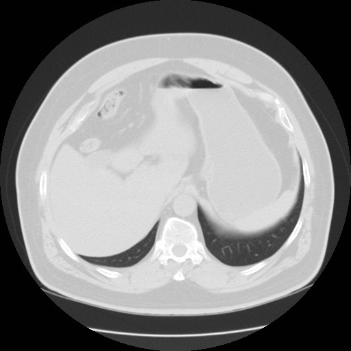File:Chilaiditi’s syndrome (Radiopaedia 27550-27756 Axial lung window 23).jpg