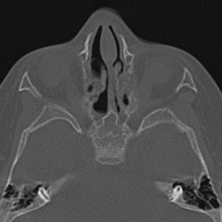 Choanal atresia (Radiopaedia 88525-105975 Axial bone window 56).jpg