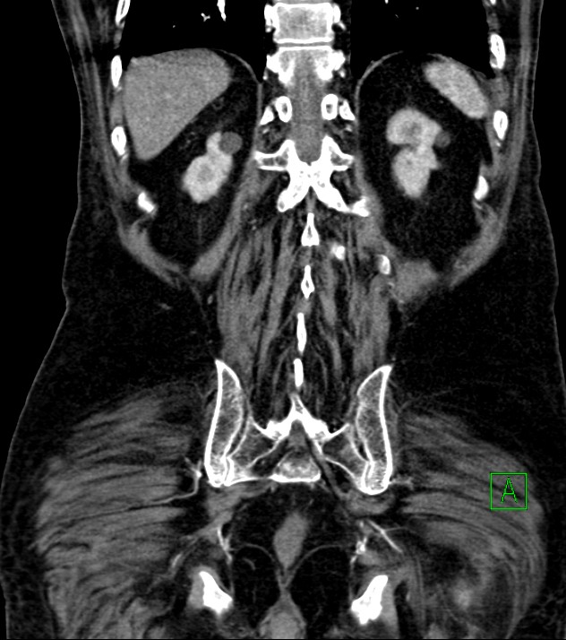 Cholangiocarcinoma with cerebral metastases (Radiopaedia 83519-98629 E 70).jpg