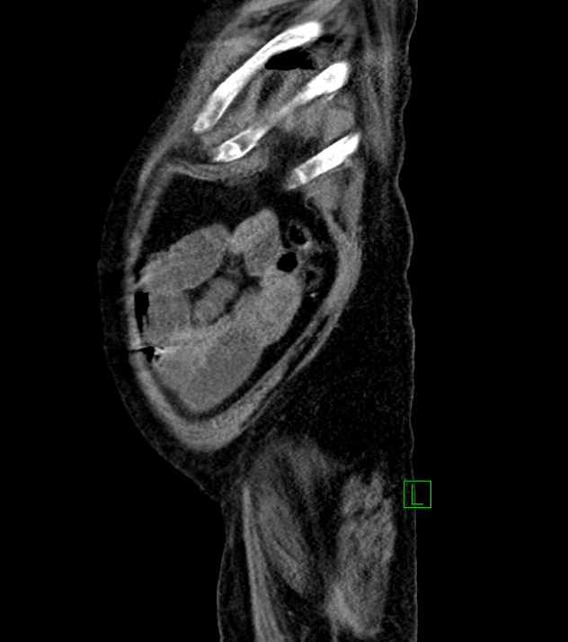 Cholangiocarcinoma with cerebral metastases (Radiopaedia 83519-98629 F 15).jpg