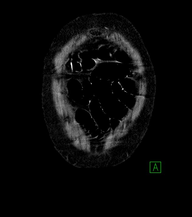 Cholangiocarcinoma with cerebral metastases (Radiopaedia 83519-98629 G 2).jpg