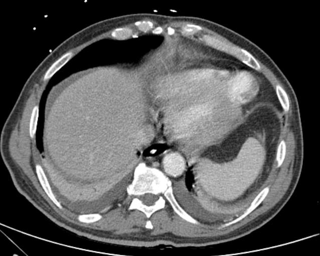 Cholecystitis - perforated gallbladder (Radiopaedia 57038-63916 A 12).jpg