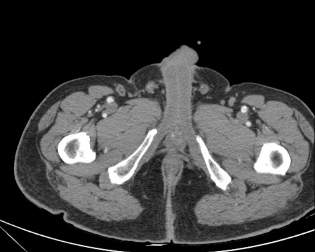 Cholecystitis - perforated gallbladder (Radiopaedia 57038-63916 A 88).jpg