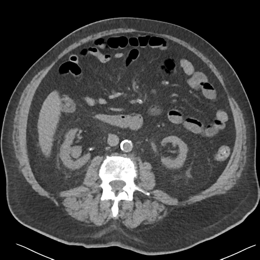 File:Choledocholithiasis and gastric polyp (Radiopaedia 48856-53895 Axial non-contrast 43).png
