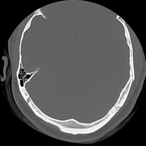 Cholesteatoma (Radiopaedia 84960-100474 Axial bone window 22).jpg