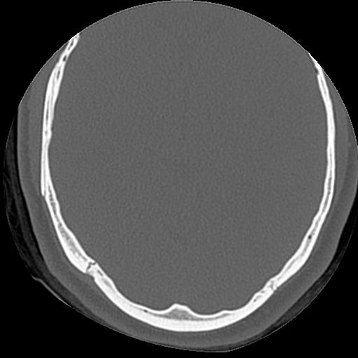 Cholesteatoma (Radiopaedia 84960-100474 Axial bone window 7).jpg
