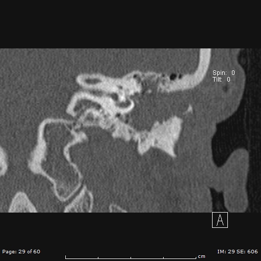 Cholesteatoma - external auditory canal (Radiopaedia 88452-105096 Coronal bone window 29).jpg
