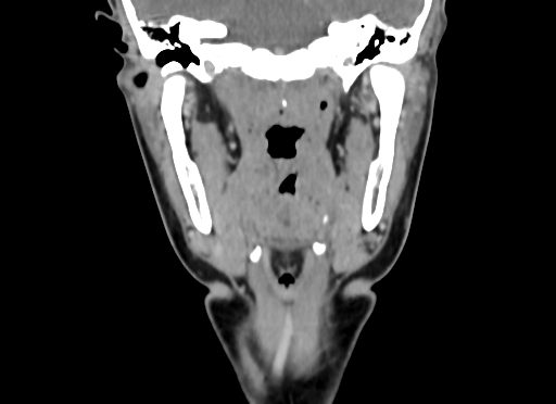 Chondroblastic osteosarcoma (Radiopaedia 67363-76741 D 64).jpg