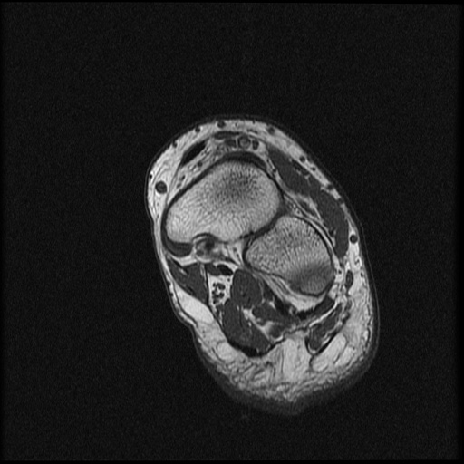 File:Chondroblastoma - midfoot (Radiopaedia 64831-73765 Short axis T1 9).jpg