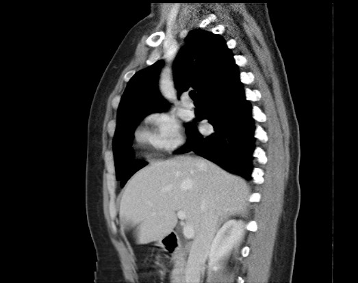 Chondrosarcoma - chest wall (Radiopaedia 65192-74199 B 37).jpg
