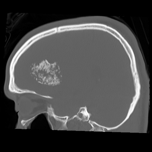 File:Chondrosarcoma - sphenoid wing (Radiopaedia 58259-67828 Sagittal bone window 20).jpg