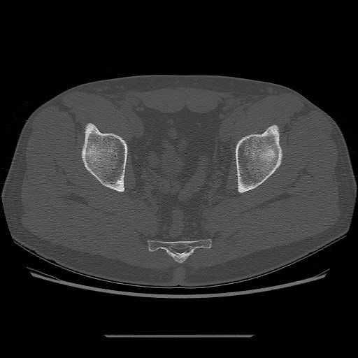 File:Chondrosarcoma of iliac wing (Radiopaedia 63861-72599 Axial bone window 89).jpg