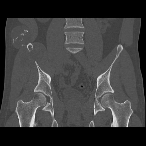 Chondrosarcoma of iliac wing (Radiopaedia 63861-72599 Coronal bone window 62).jpg