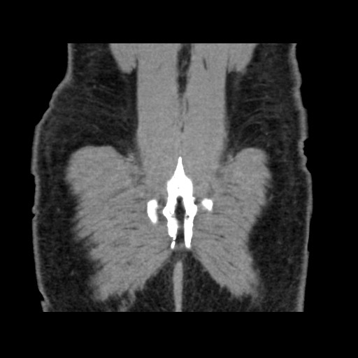 Chondrosarcoma of iliac wing (Radiopaedia 63861-72599 Coronal non-contrast 103).jpg