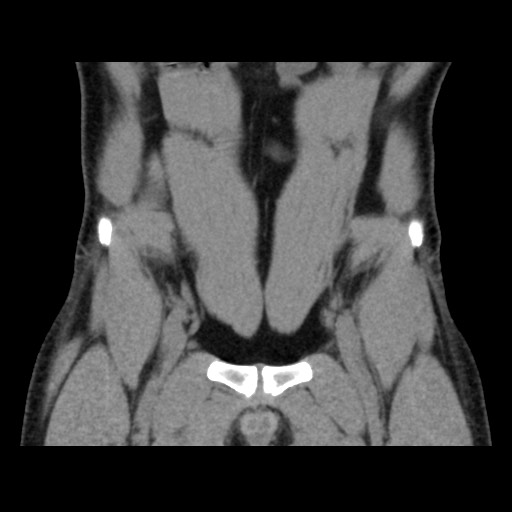 Chondrosarcoma of iliac wing (Radiopaedia 63861-72599 Coronal non-contrast 30).jpg