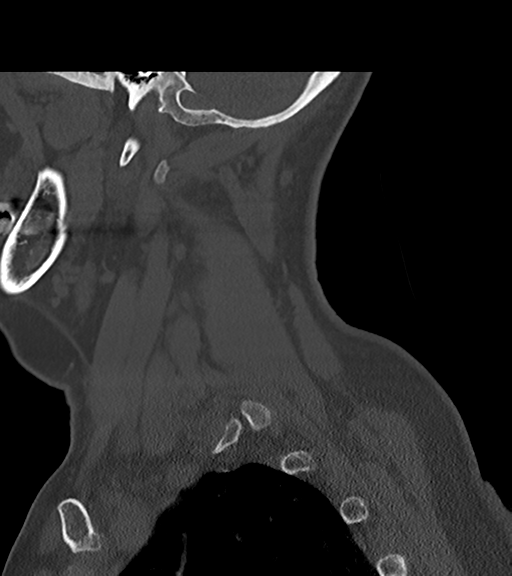 File:Chordoma (C4 vertebra) (Radiopaedia 47561-52188 Sagittal bone window 15).png
