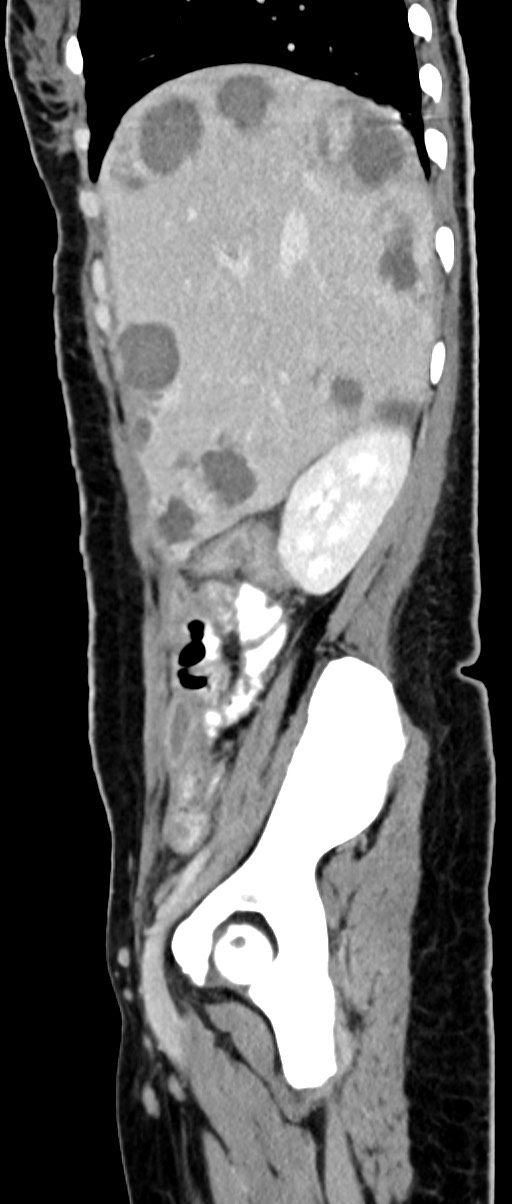Choriocarcinoma liver metastases (Radiopaedia 74768-85766 C 129).jpg