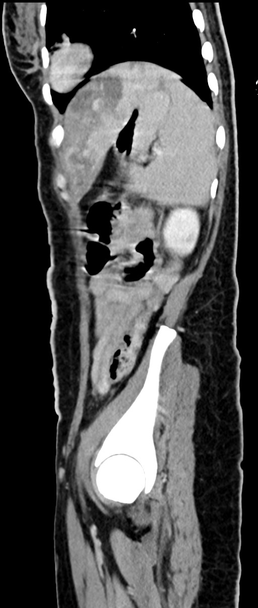 Choriocarcinoma liver metastases (Radiopaedia 74768-85766 C 60).jpg