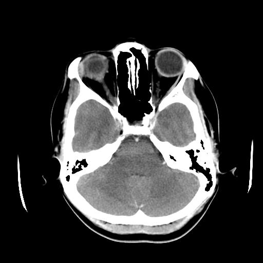 File:Choriocarcinoma of ovary with cerebral and pulmonary metastases (Radiopaedia 25983-26118 A 6).jpg