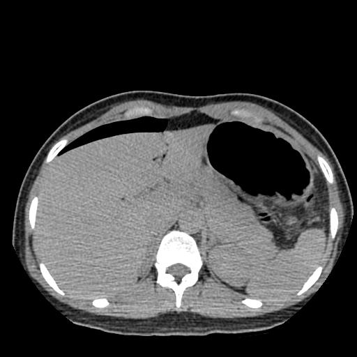 File:Choriocarcinoma of ovary with cerebral and pulmonary metastases (Radiopaedia 25983-26119 Axial non-contrast 72).jpg
