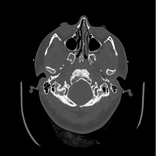 Choroid plexus papilloma extending into the cerebellopontine angle cistern (Radiopaedia 85941-101833 Axial bone window 20).png