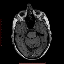 Choroid plexus xanthogranuloma (Radiopaedia 67843-77270 Axial T1 113).jpg