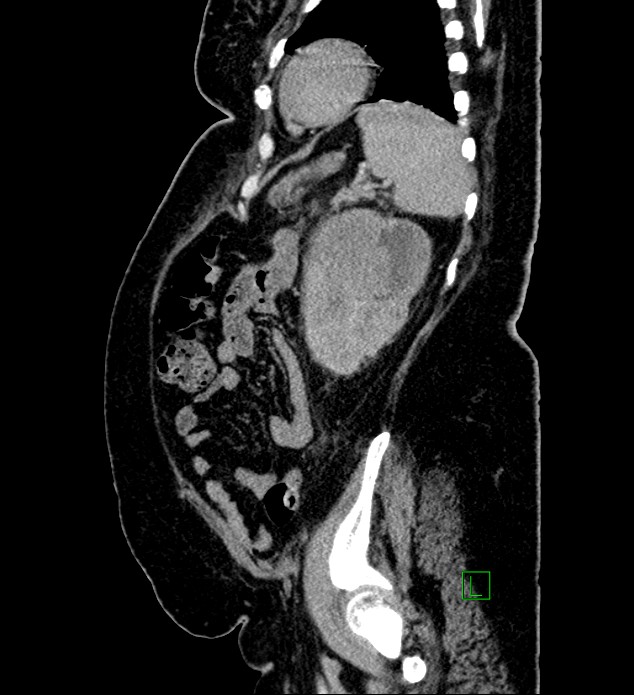 Chromophobe renal cell carcinoma (Radiopaedia 84239-99519 G 30).jpg
