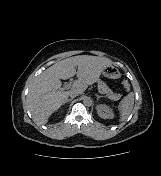 Chromophobe renal cell carcinoma (Radiopaedia 84337-99693 Axial non-contrast 33).jpg