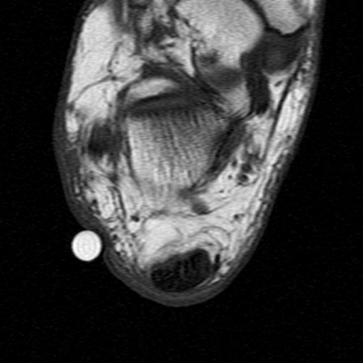 File:Chronic Achilles tendon rupture (Radiopaedia 15262-15100 Axial T1 20).jpg