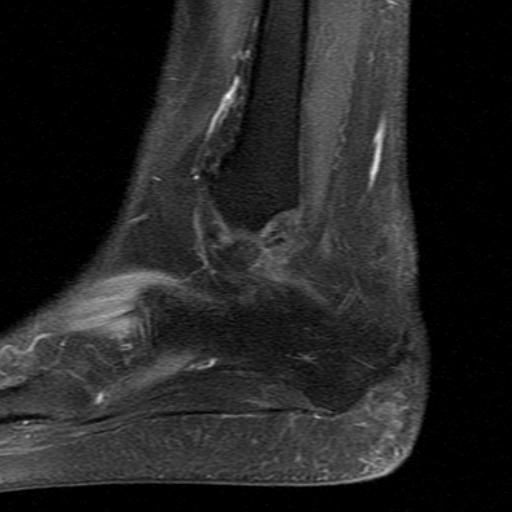 File:Chronic Achilles tendon rupture (Radiopaedia 15262-15100 C 2).jpg