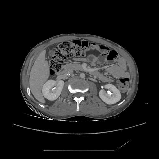File:Chronic IVC thrombosis and resultant IVC filter malposition (Radiopaedia 81158-94800 A 85).jpg