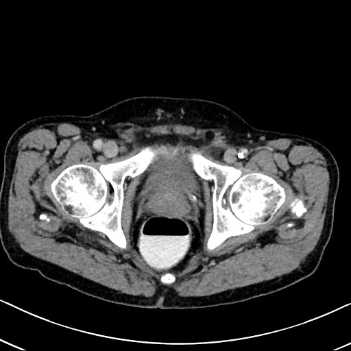 Chronic appendicitis complicated by appendicular abscess, pylephlebitis and liver abscess (Radiopaedia 54483-60700 B 141).jpg