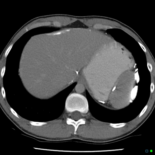 File:Chronic barium peritonitis and small bowel obstruction (Radiopaedia 29151-29548 D 1).jpg