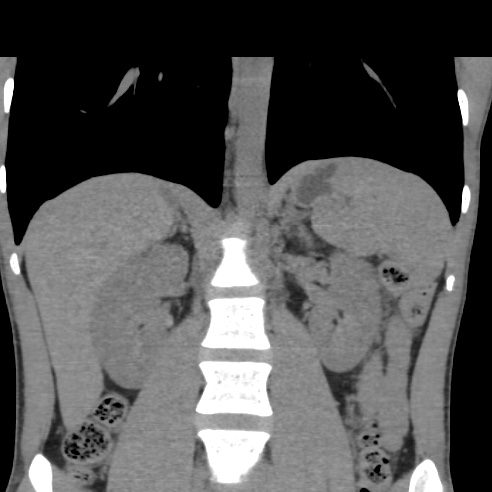 File:Chronic calcific pancreatitis (Radiopaedia 56280-62953 Coronal non-contrast 20).jpg